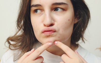 ¿Te salen granos en verano? ¡Descubre como combatirlos con nuestros trucos y consejos!